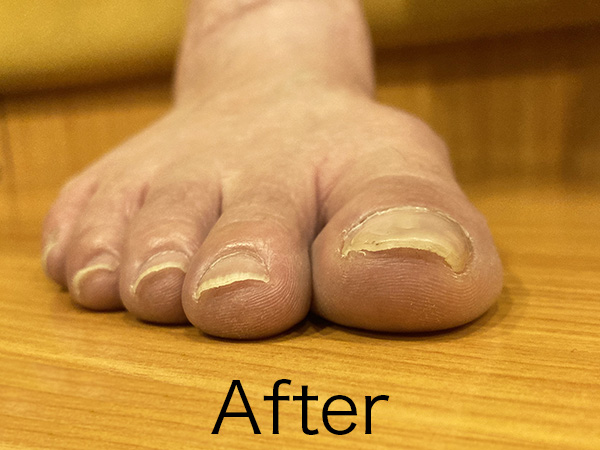 巻き爪矯正 施術後