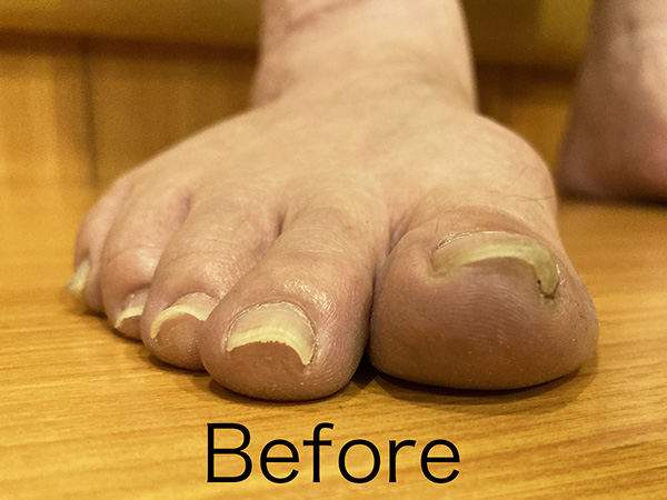 巻き爪矯正 施術前